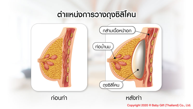 เสริมหน้าอก